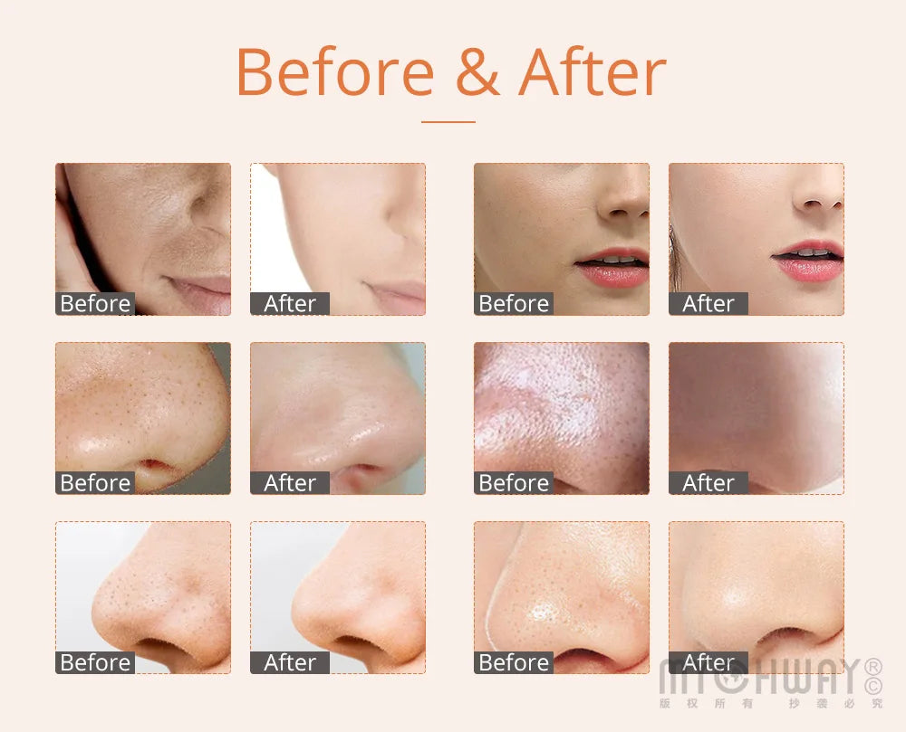 3 in 1 Ultrasound Dermabrasion Device